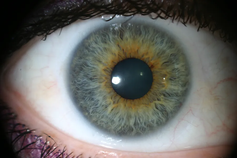 Irisdiagnose Naturheilkunde Irisdiagnose
