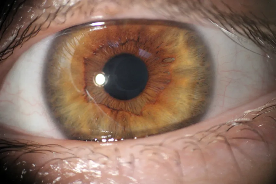 Irisdiagnose Naturheilkunde Irisdiagnose
