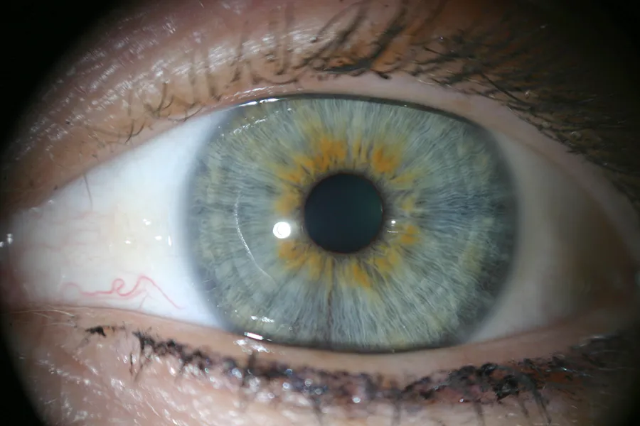 Irisdiagnose